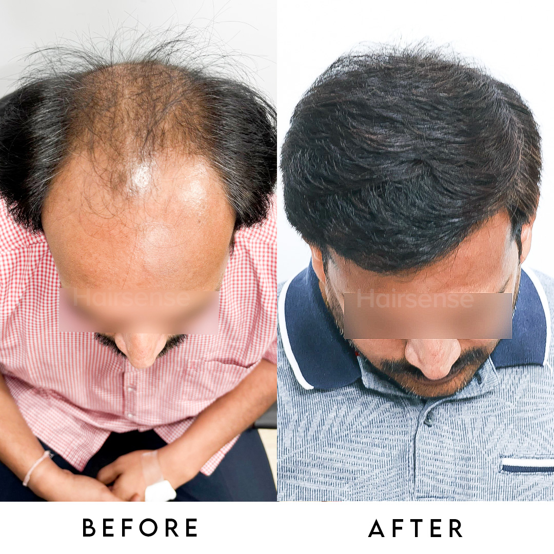 Hair transplant result 1